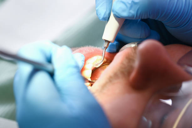 Best Emergency Wisdom Teeth Removal in Wagon Wheel, AZ